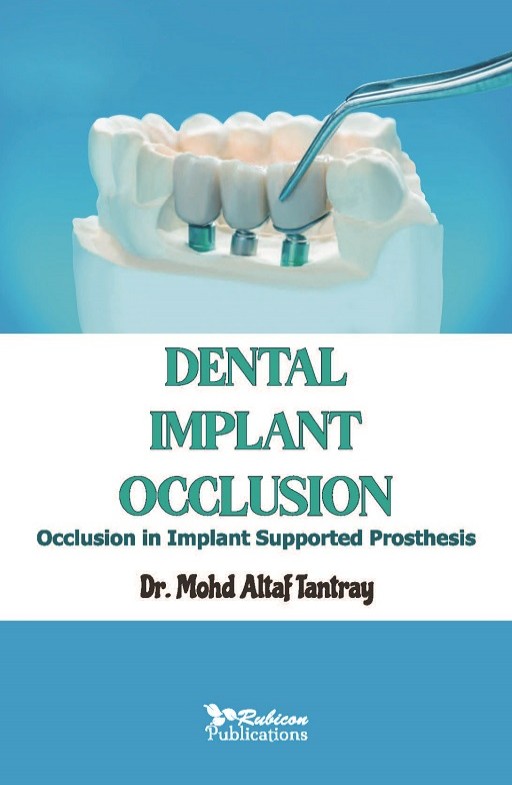 Dental Implant Occlusion: Occlusion in Implant Supported Prosthesis